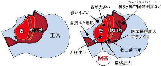 いびきをかく仕組み