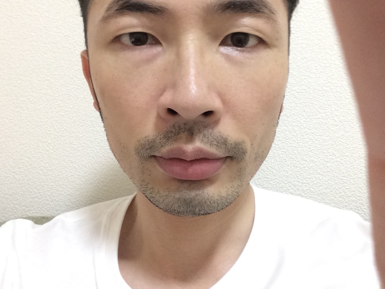 ひげ脱毛6回目の効果
