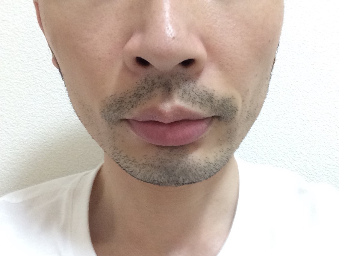 ひげ脱毛6回目の効果