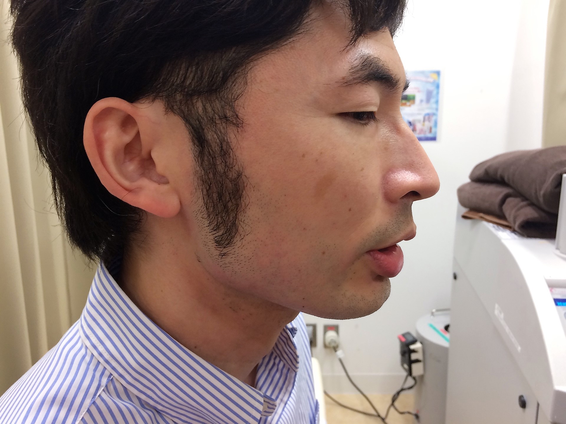 頬ひげ脱毛施術後の写真
