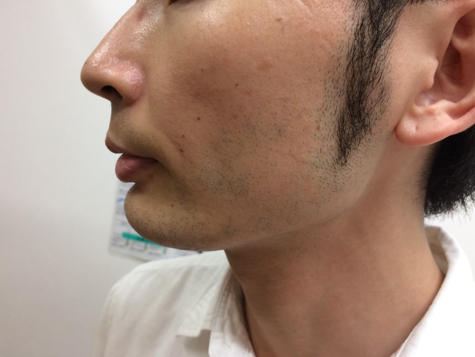頬ひげ脱毛3回目の施術前
