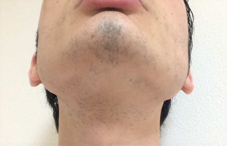ひげ脱毛8回目の効果