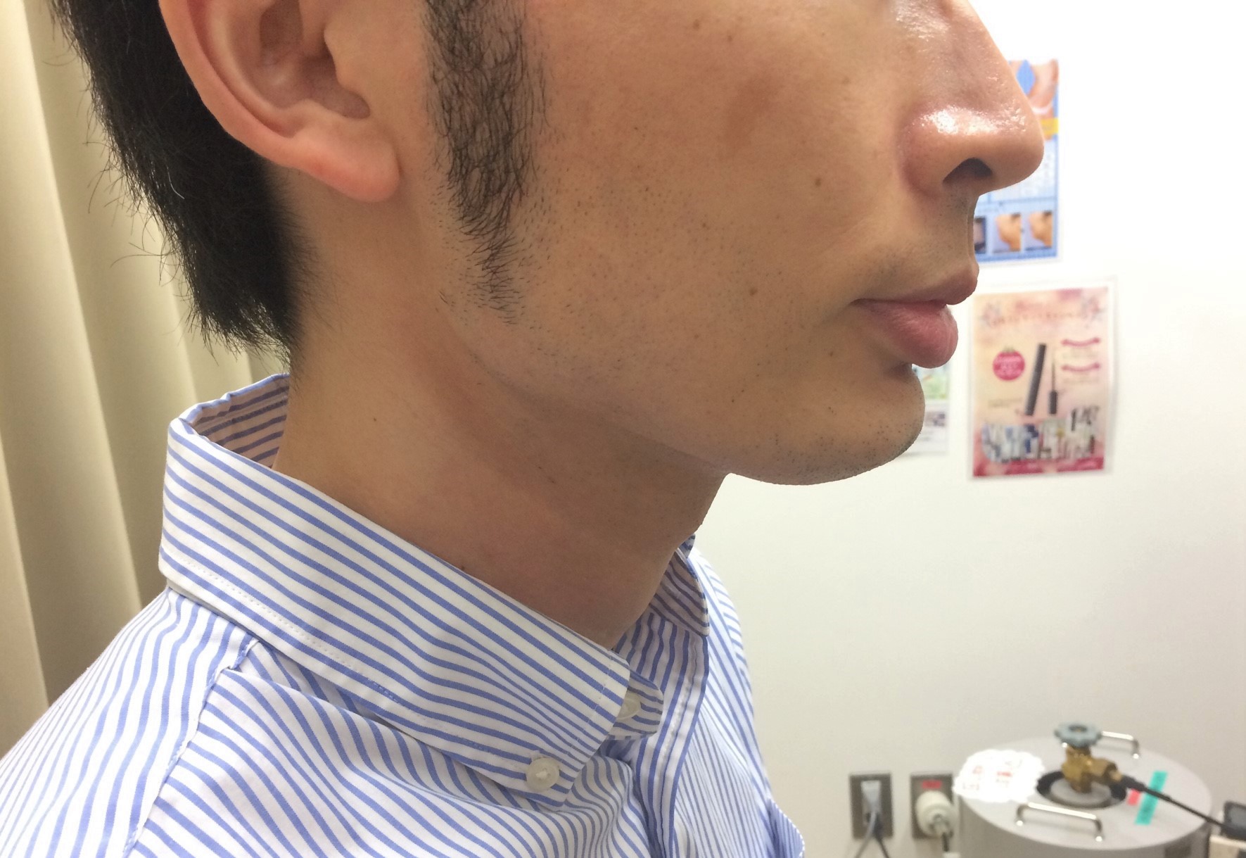 頬ひげ脱毛3回目の施術前