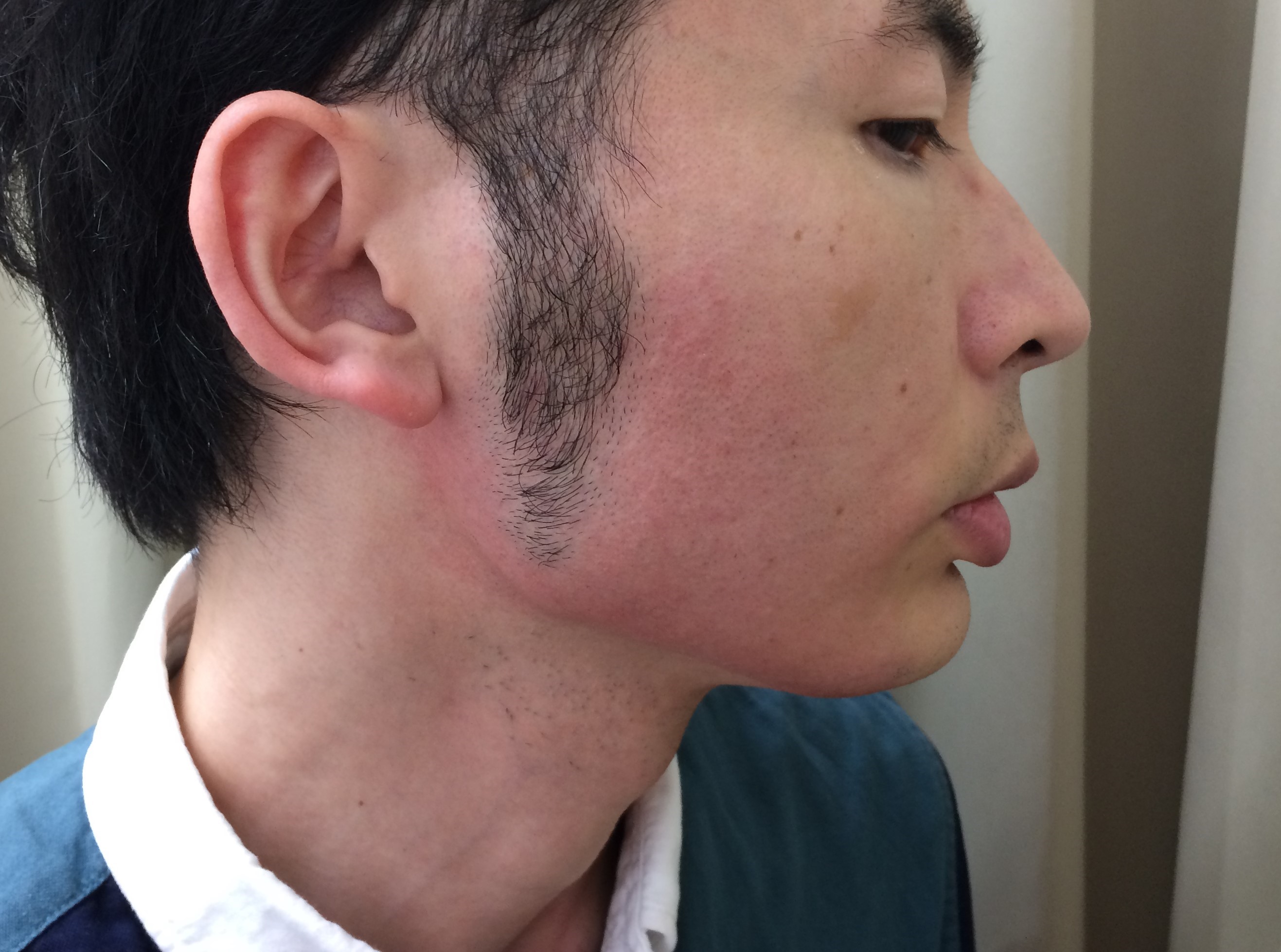 頬ひげ脱毛5回目の施術後