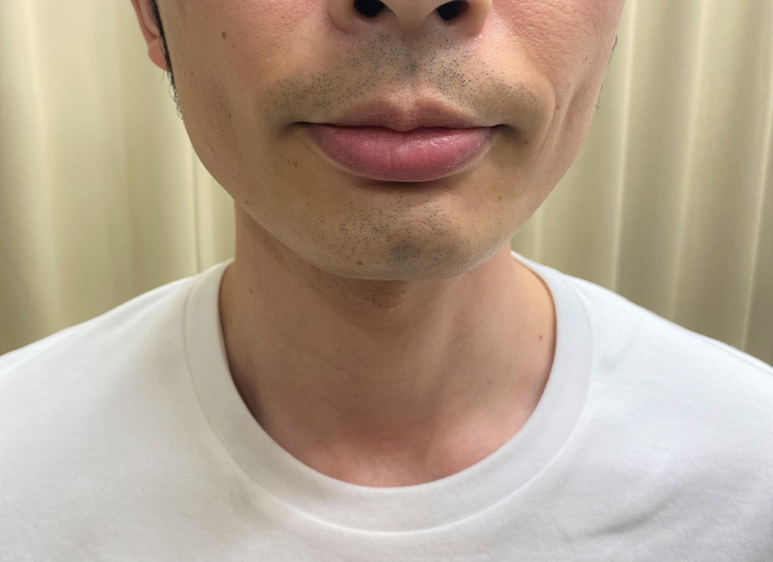 ひげ脱毛11回目施術前