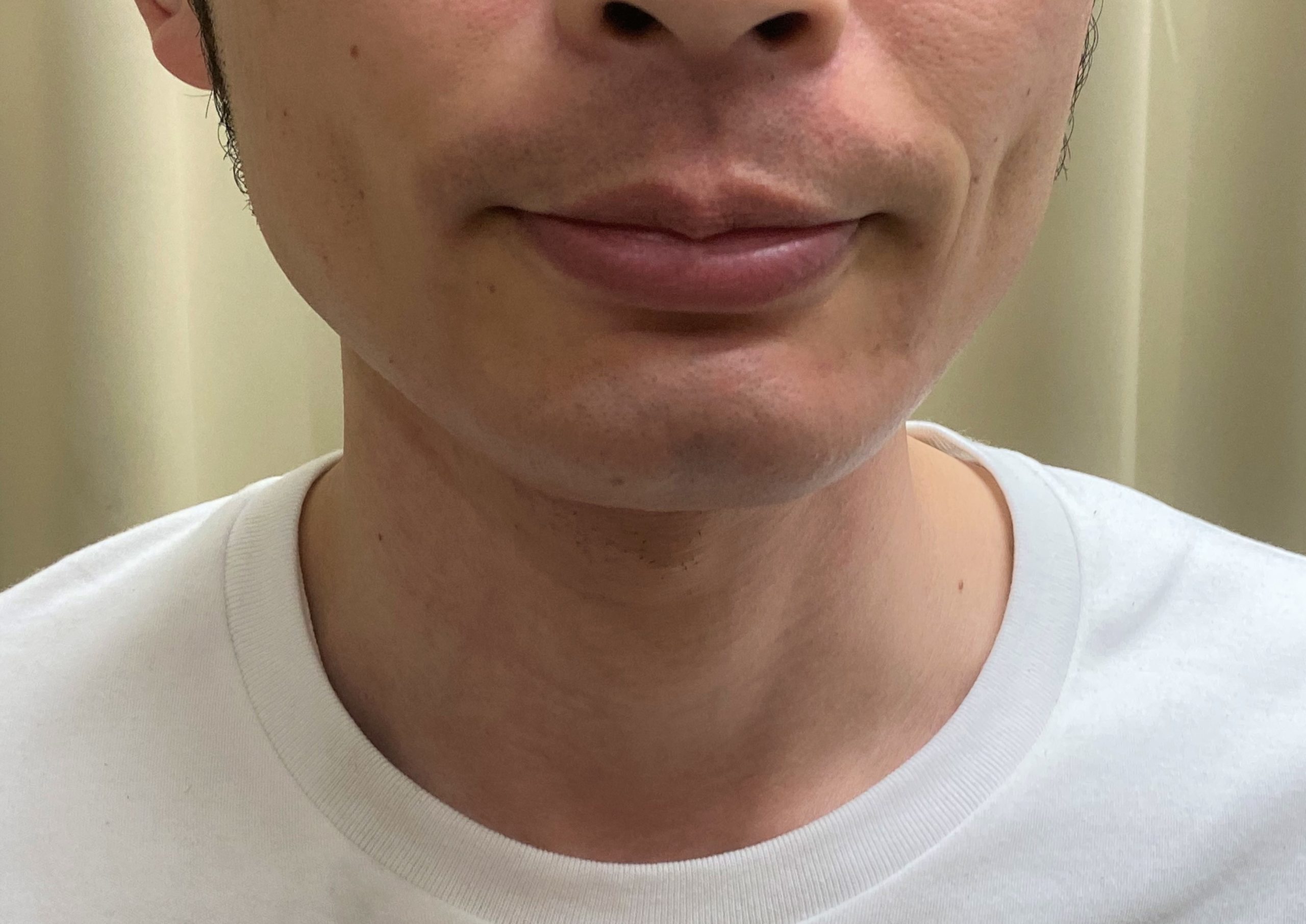 ひげ脱毛11回目施術後