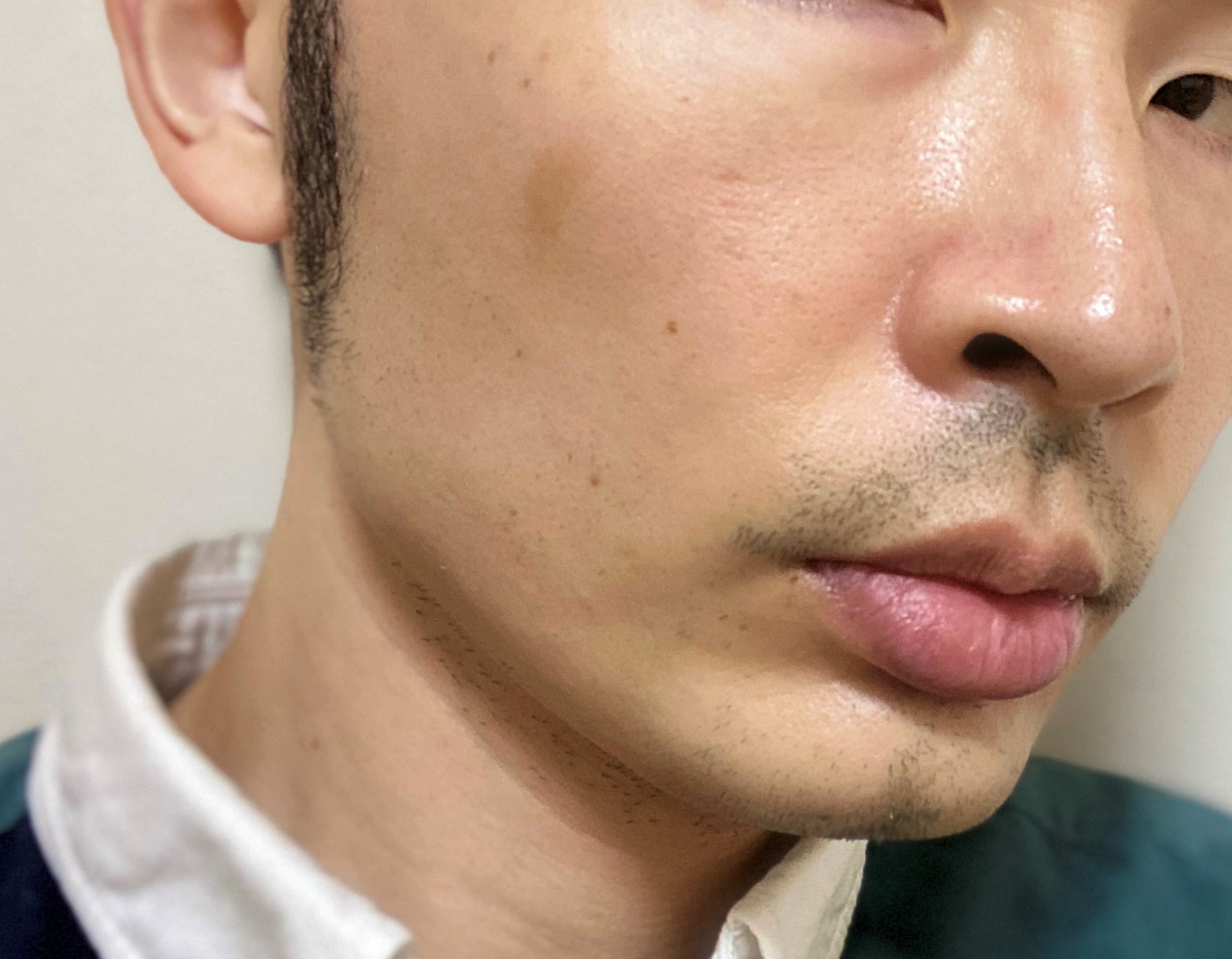 頬ヒゲ脱毛6回目の効果