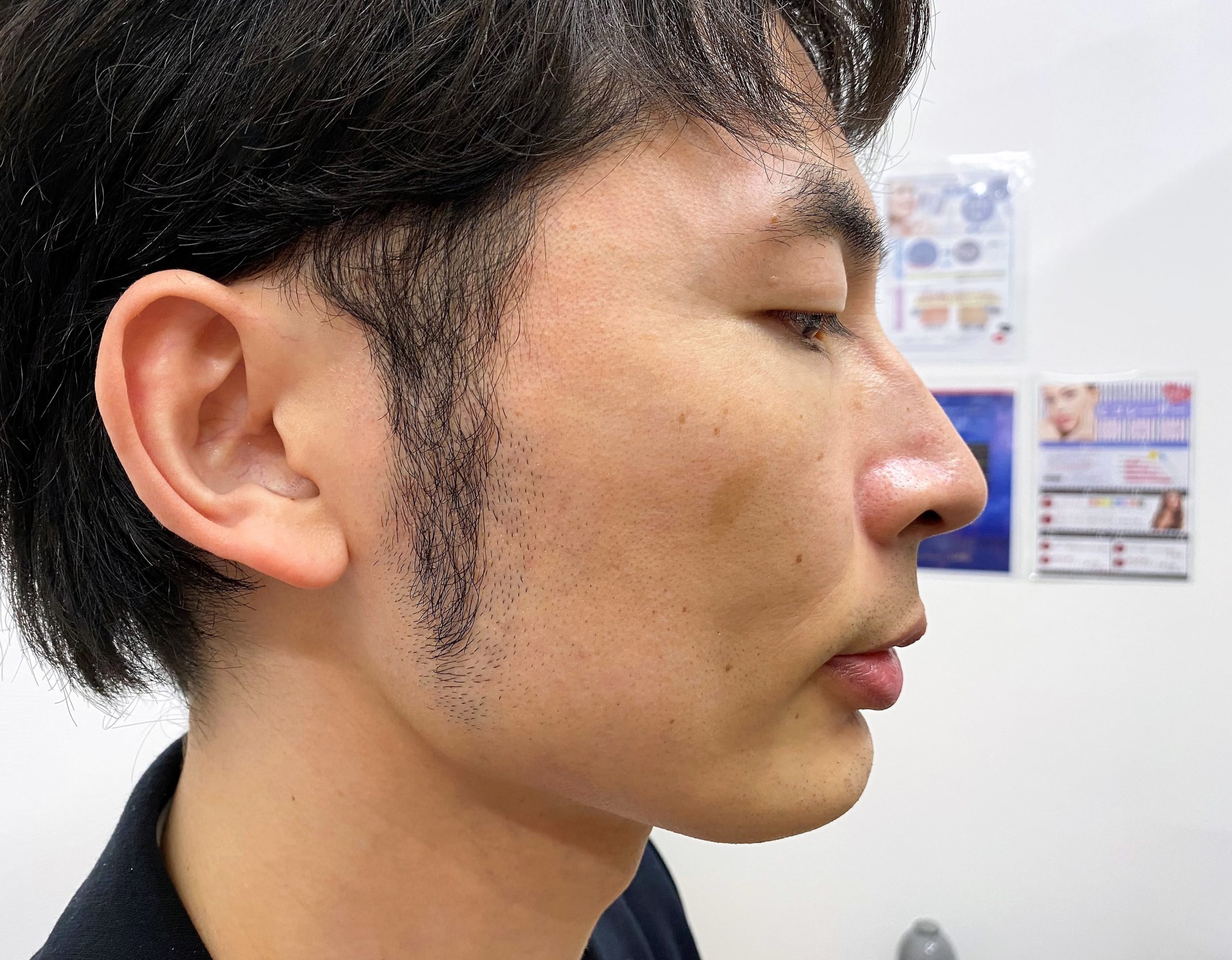 頬ひげ脱毛6回目施術前