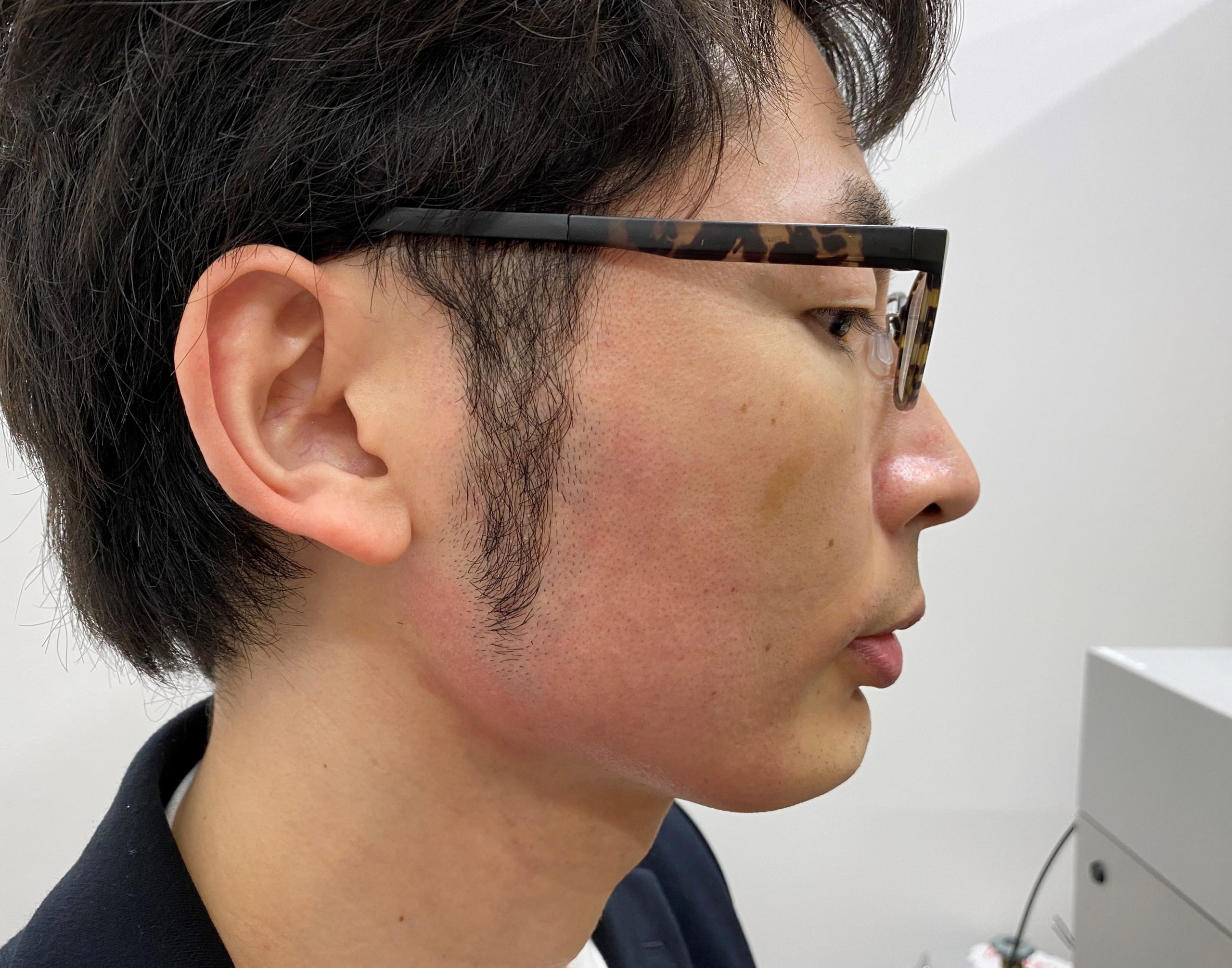 頬ひげ脱毛6回目施術後