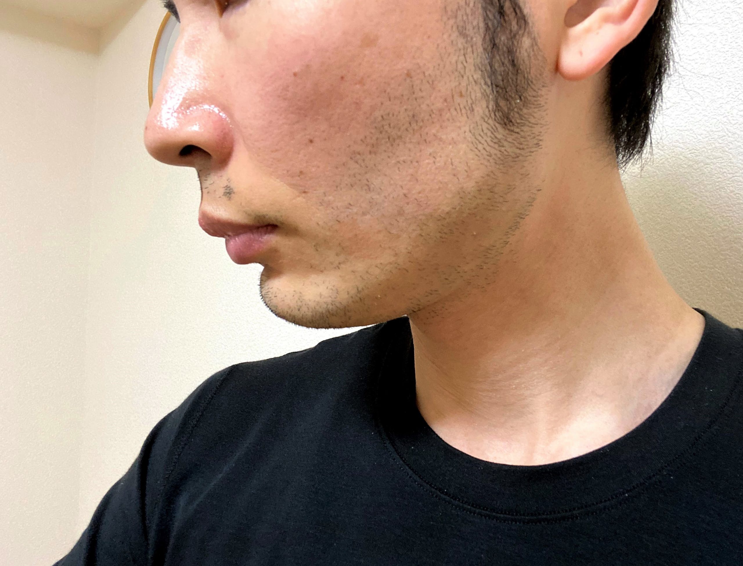 脱毛後に再び生えた頬ヒゲ