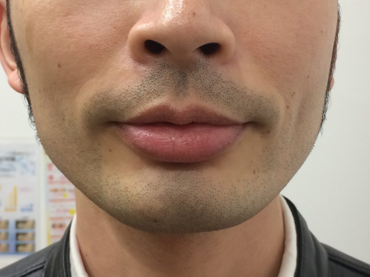 ひげ脱毛2回目の施術前