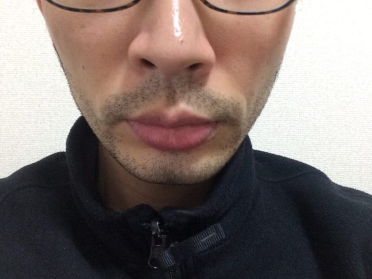 ひげ脱毛3回目の効果