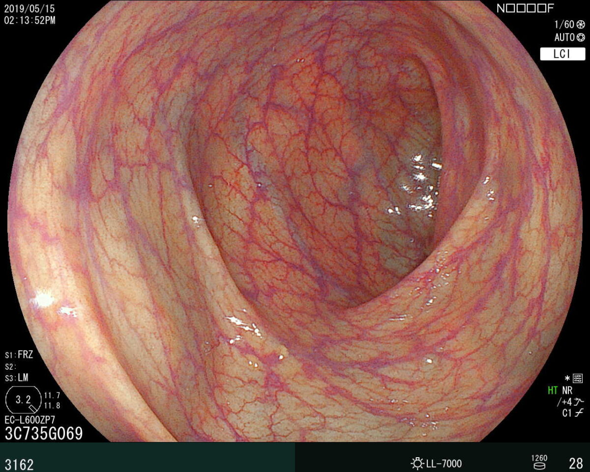 大腸内視鏡検査で確認された下行結腸の部分