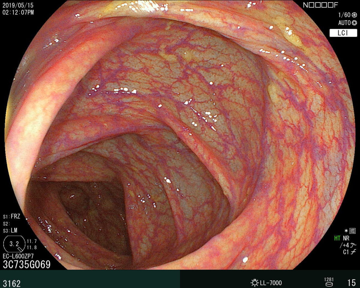 大腸内視鏡検査で確認された横行結腸の部分
