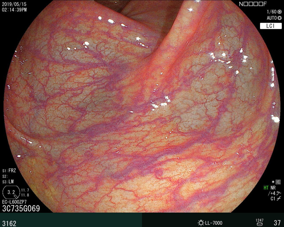 大腸内視鏡検査で確認されたS字結腸の部分