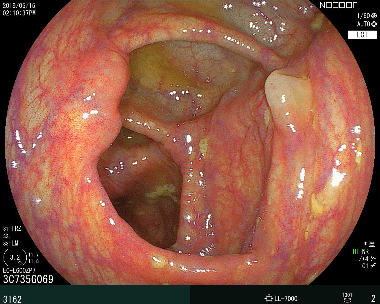 大腸内視鏡検査で確認された盲腸の部分