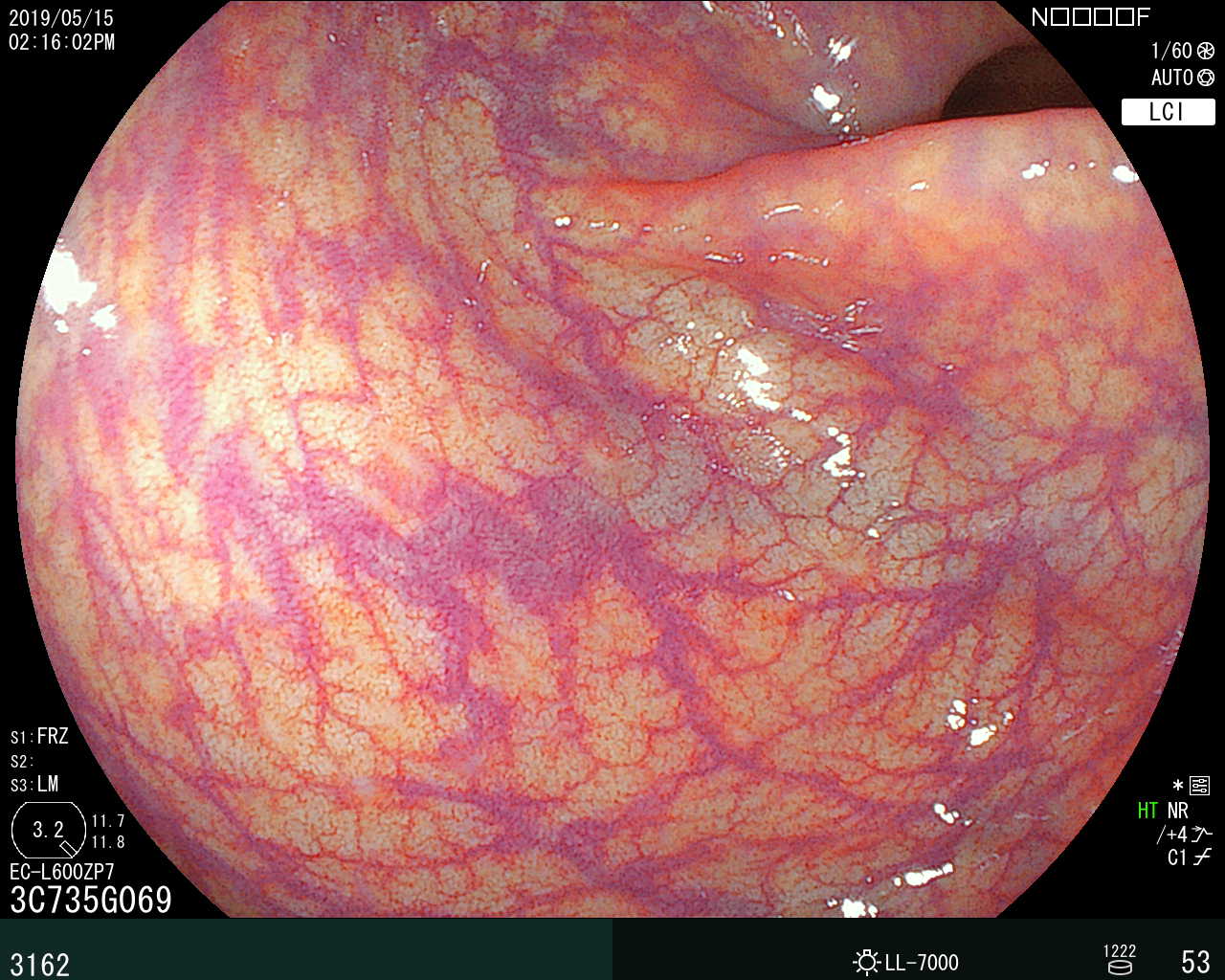 大腸内視鏡検査で確認した直腸