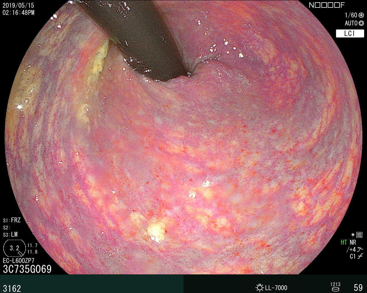 大腸内視鏡検査で確認した肛門