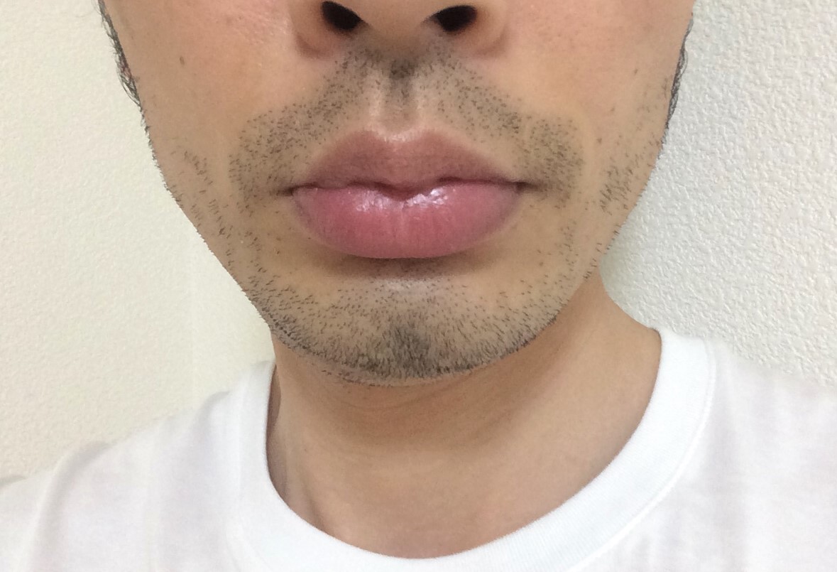 ひげ脱毛7回目の効果の途中