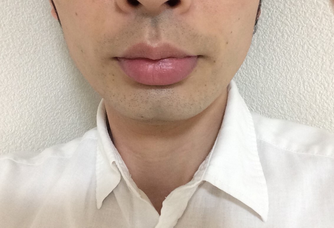 ひげ脱毛7回目の効果