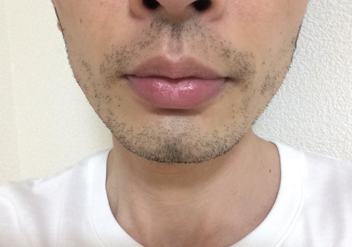 ひげ脱毛7回目の効果