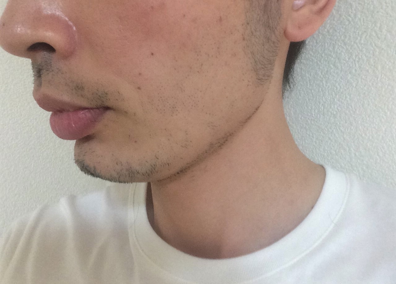 頬ひげ脱毛2回目の効果