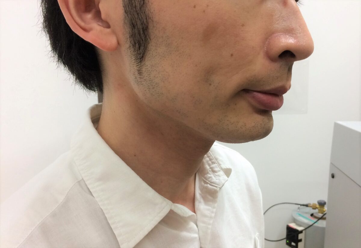 頬ひげ脱毛3回目の施術前
