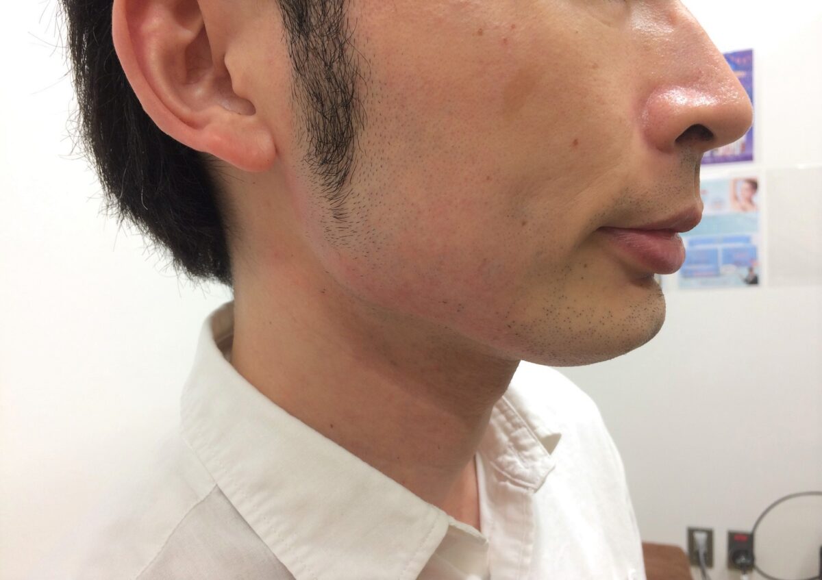 頬ひげ脱毛2回目の施術後