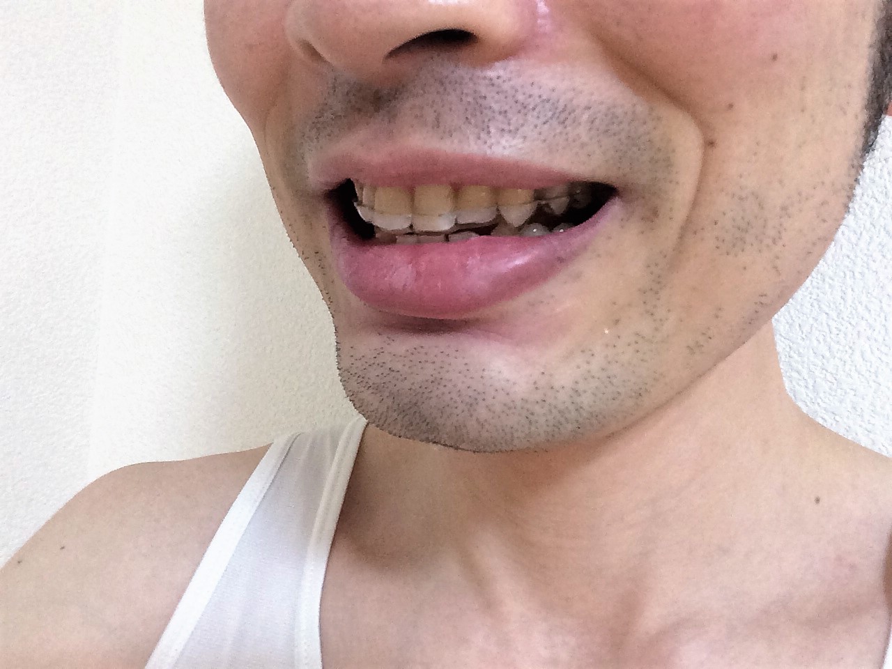 夜間用マウスピースをはめた様子