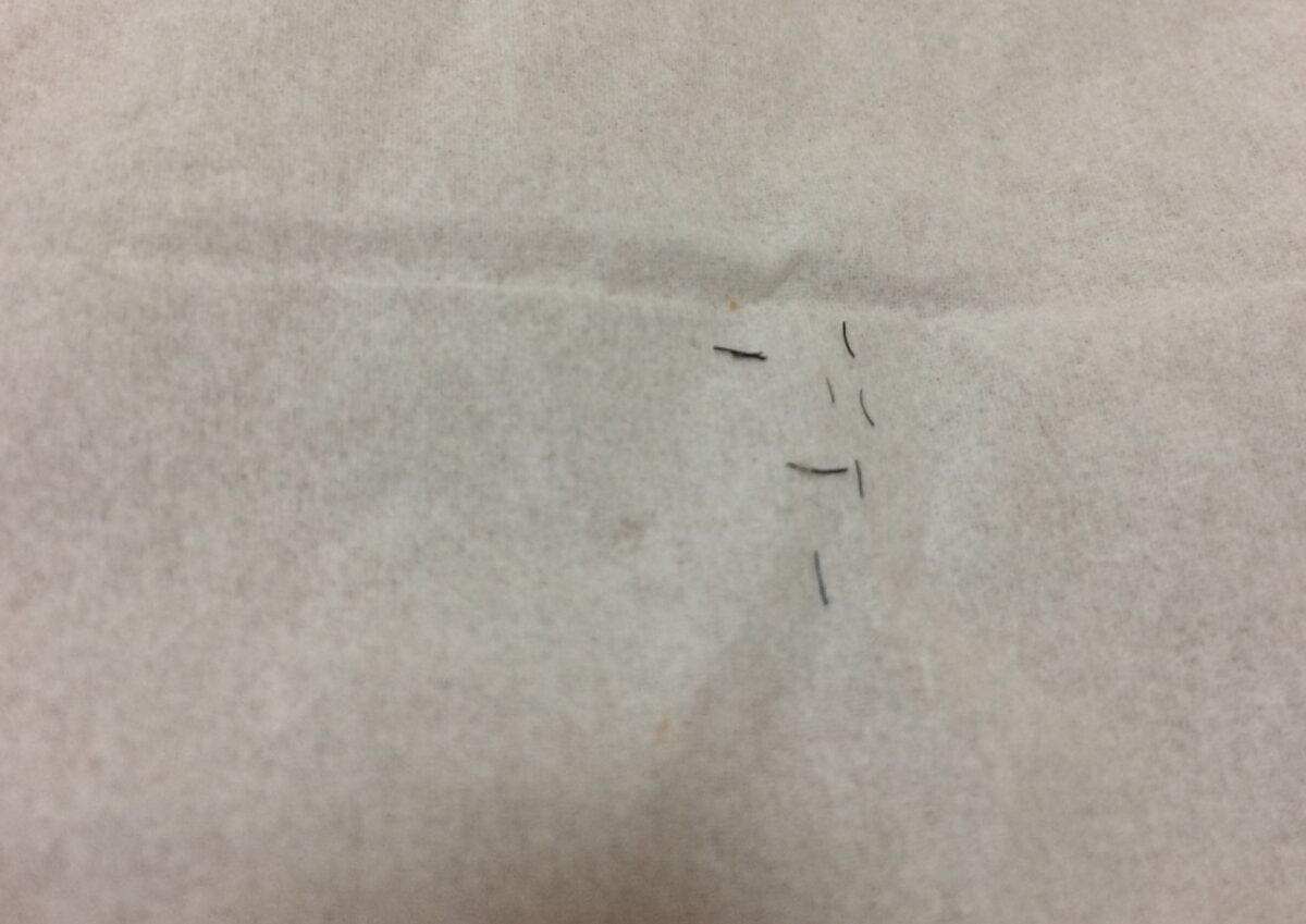 脱毛によって抜けたひげ