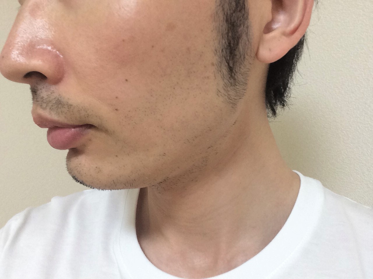 頬ひげ脱毛3回目の効果