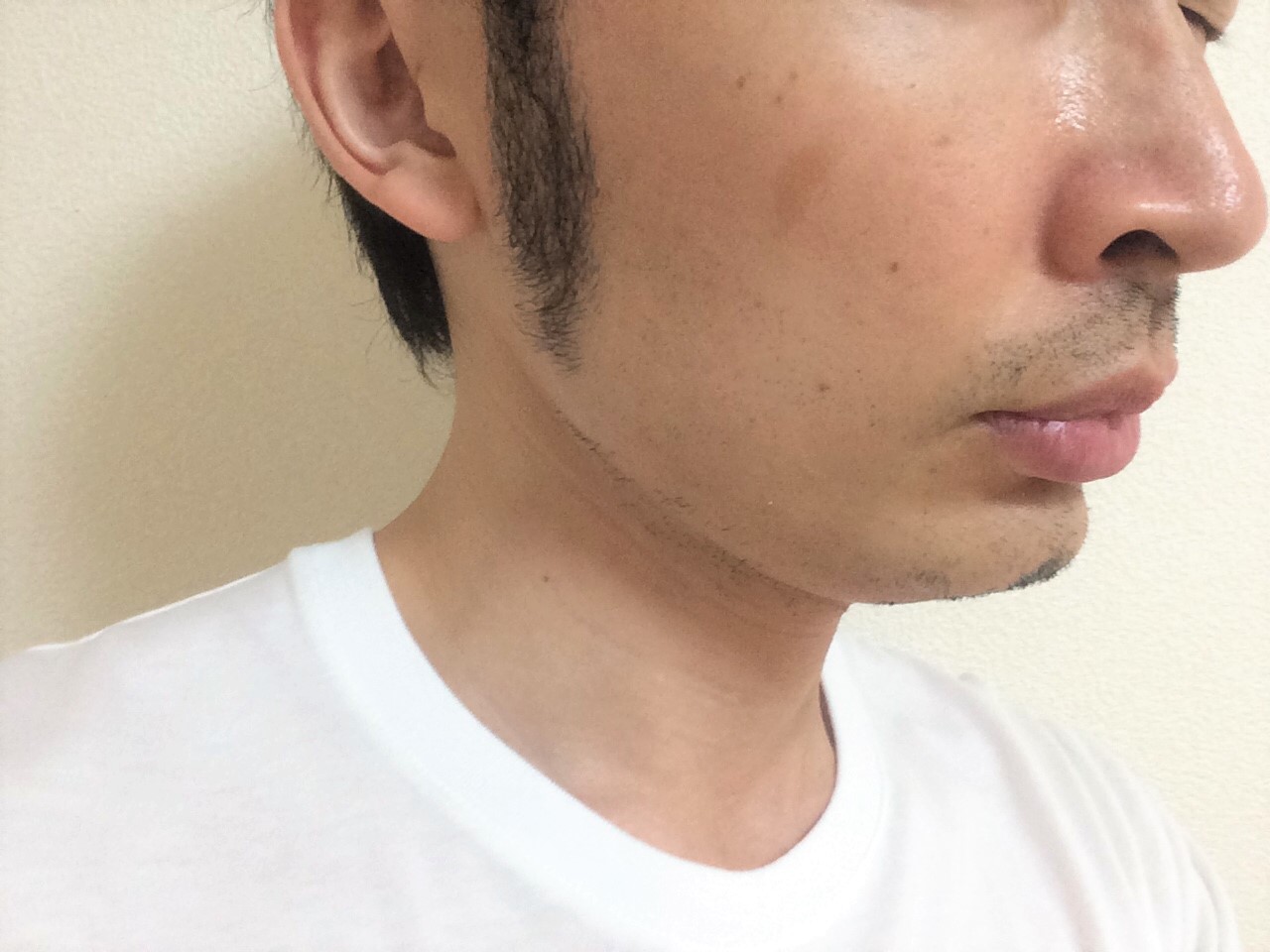頬ひげ脱毛3回目の効果