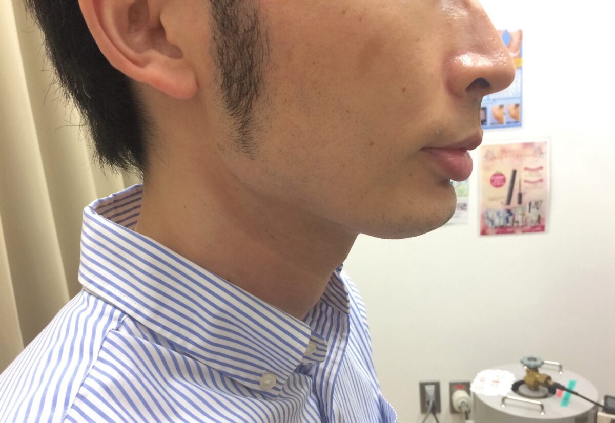頬ひげ脱毛3回目の施術前