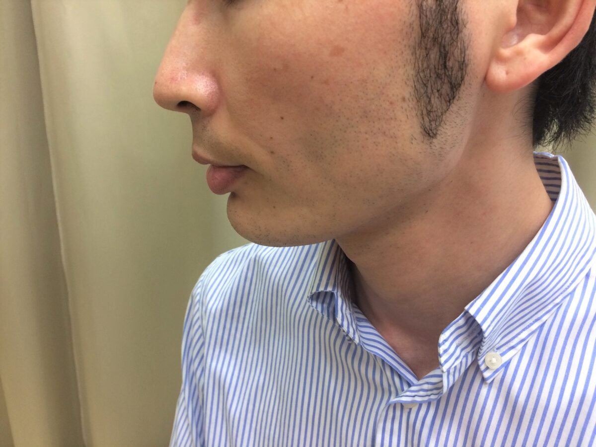 http://iryowriter.net/2019/08/25/【頬ひげ脱毛】わずか2回の施術でほとんど生えな/