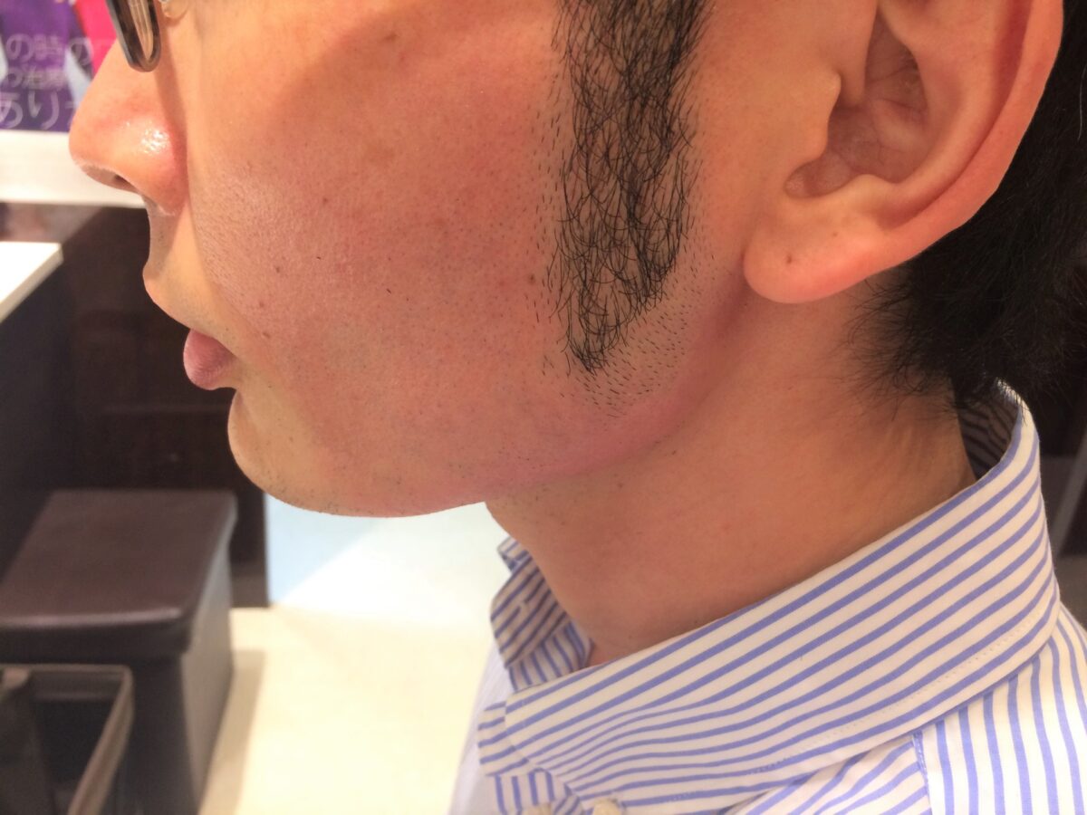 頬ひげ脱毛3回目の施術後