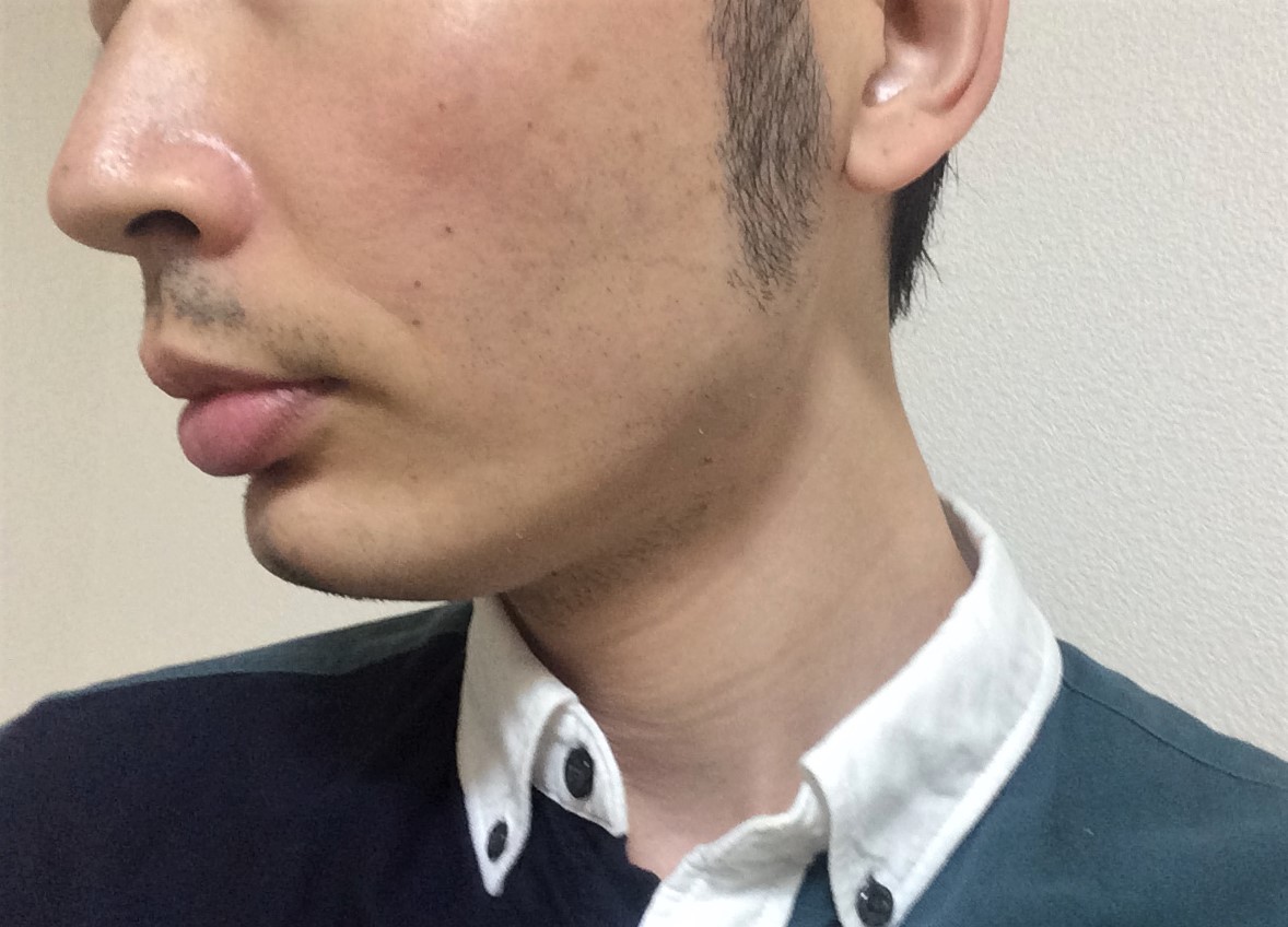 頬ひげ脱毛4回目の効果