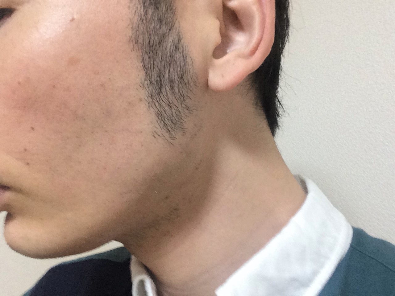 頬ひげ脱毛4回目の効果