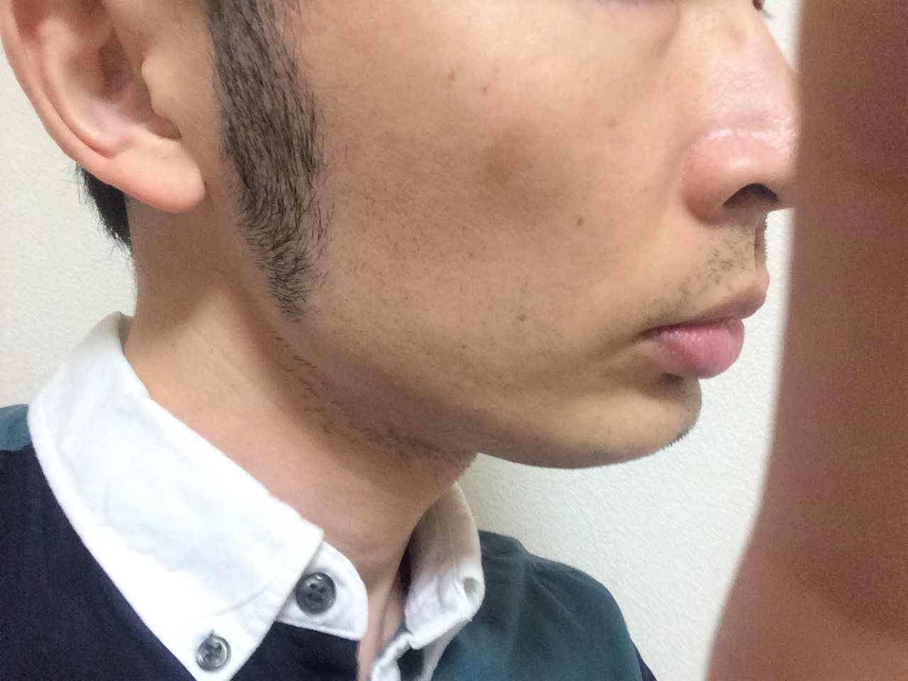 頬ひげ脱毛4回目の効果