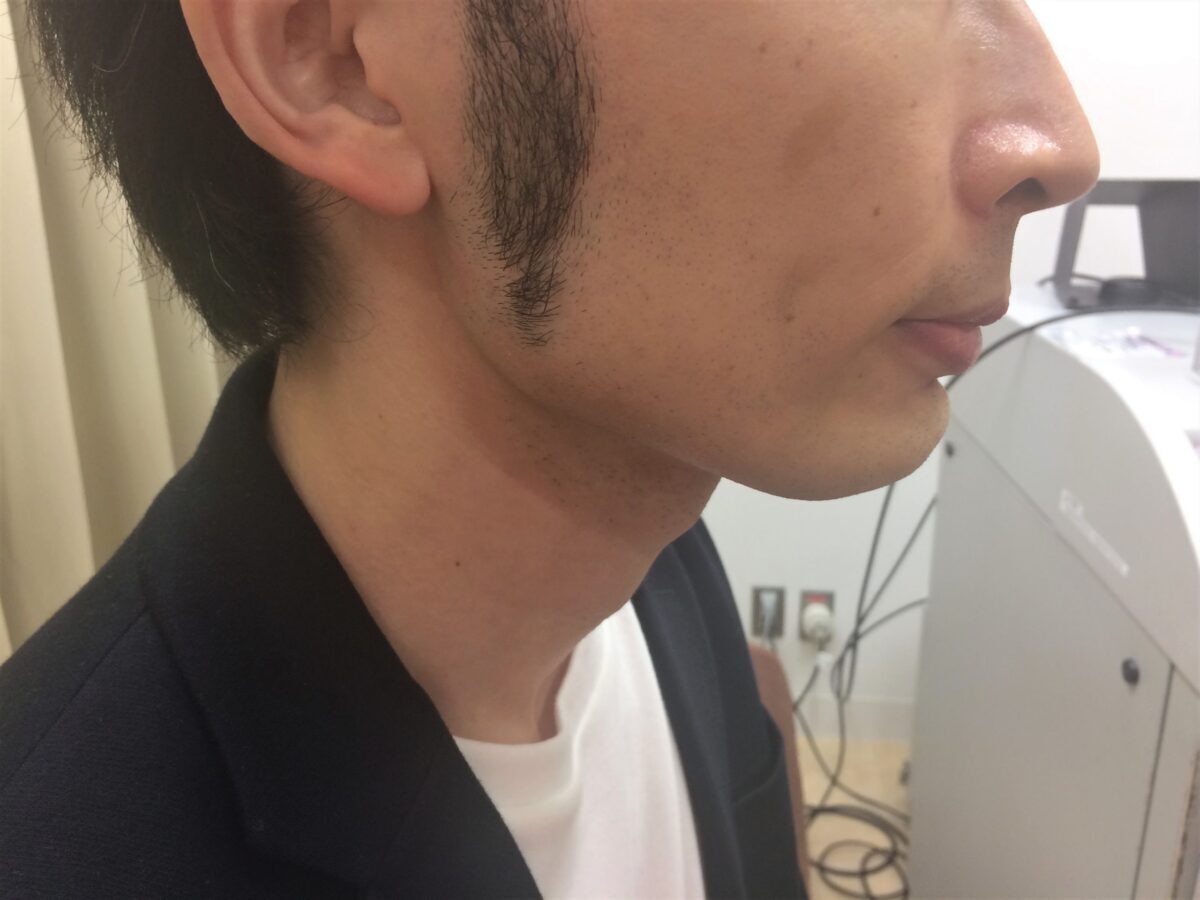 頬ひげ脱毛4回目の施術前