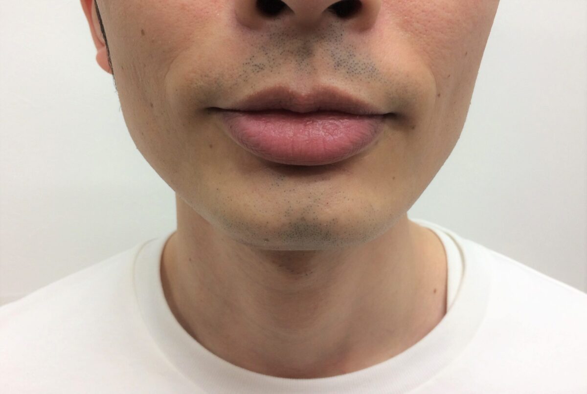 ひげ脱毛10回目の施術前