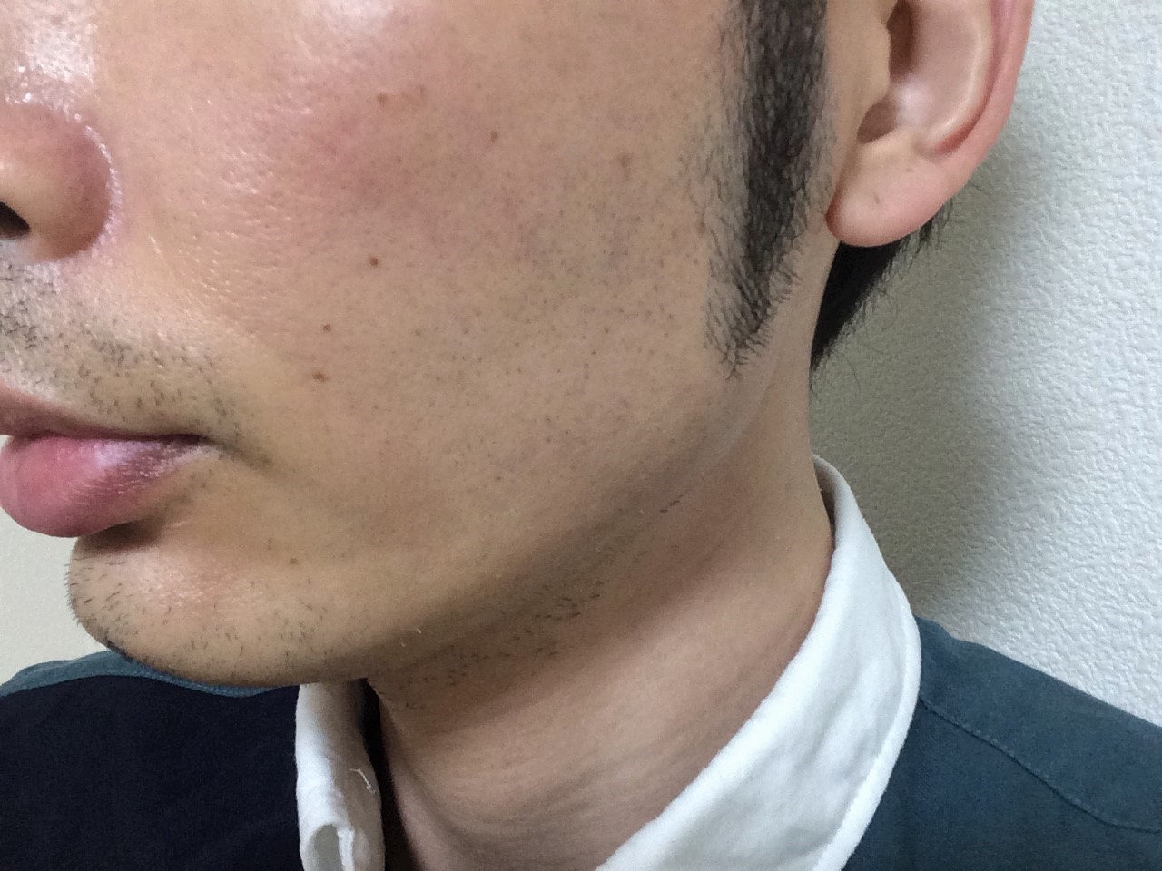 頬ひげ脱毛5回目の効果