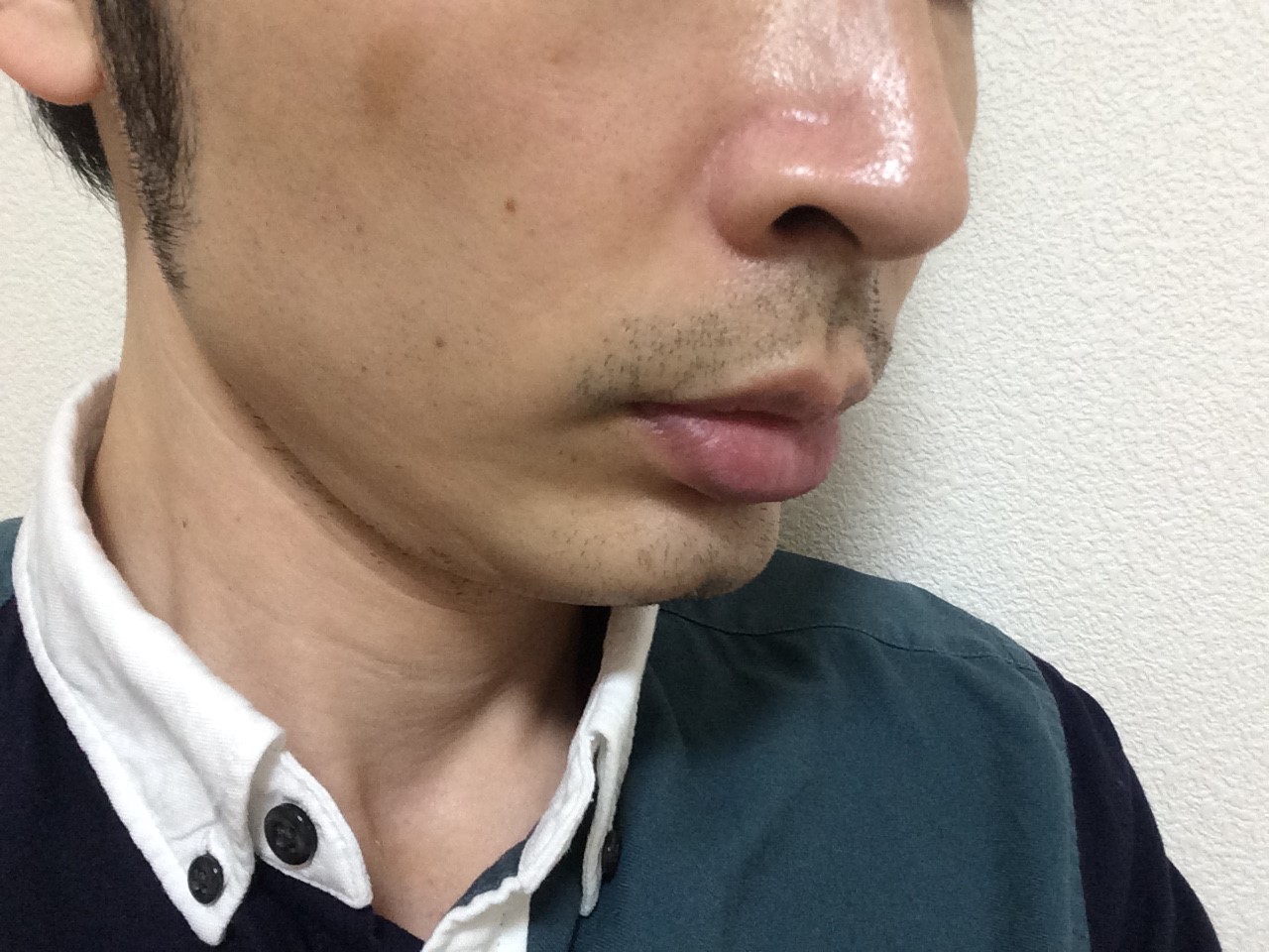 頬ひげ脱毛5回目の効果