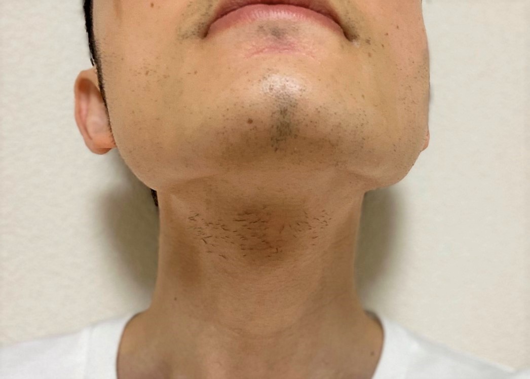 ヒゲ脱毛11回目の効果