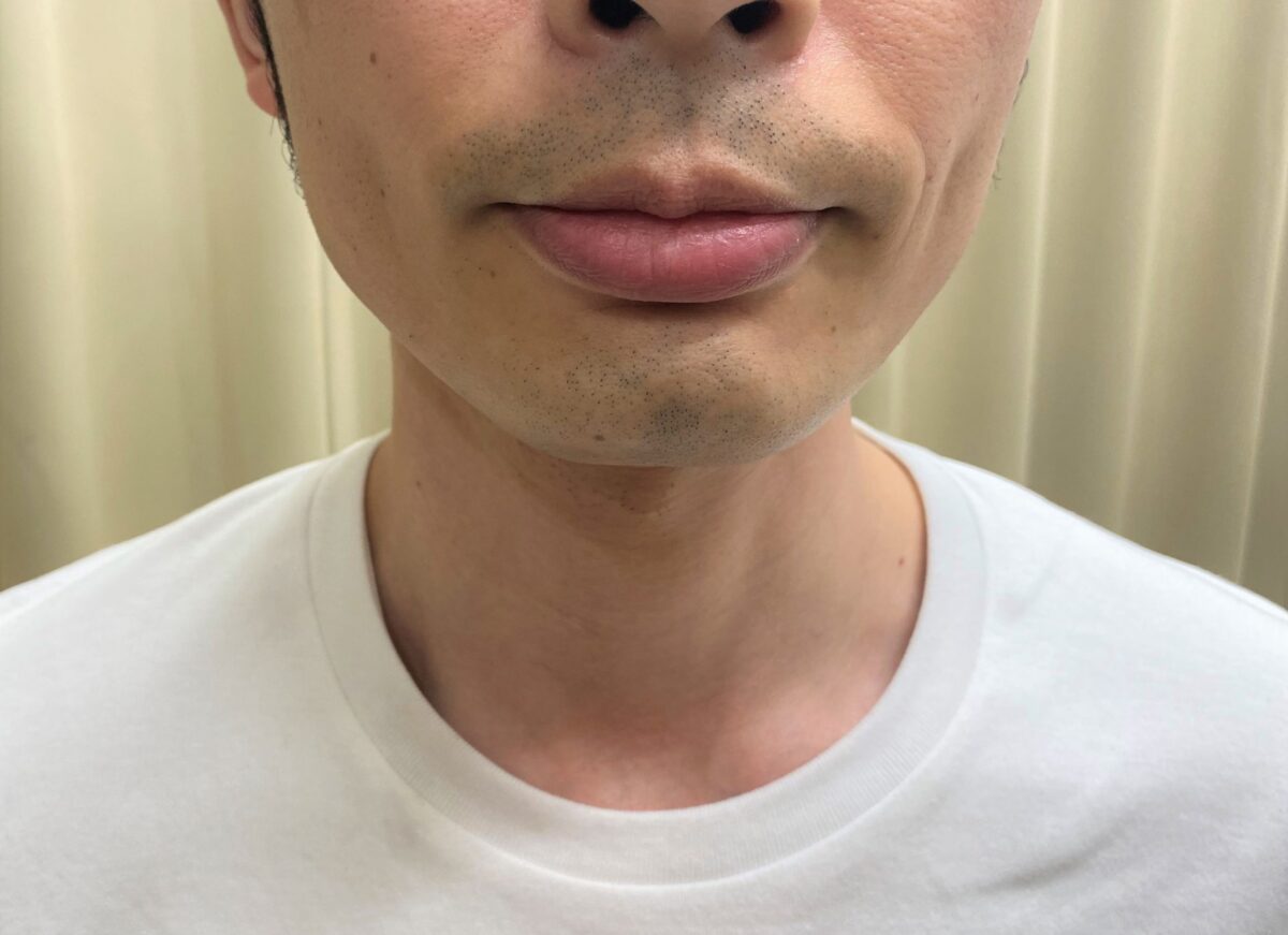 ひげ脱毛11回目施術前