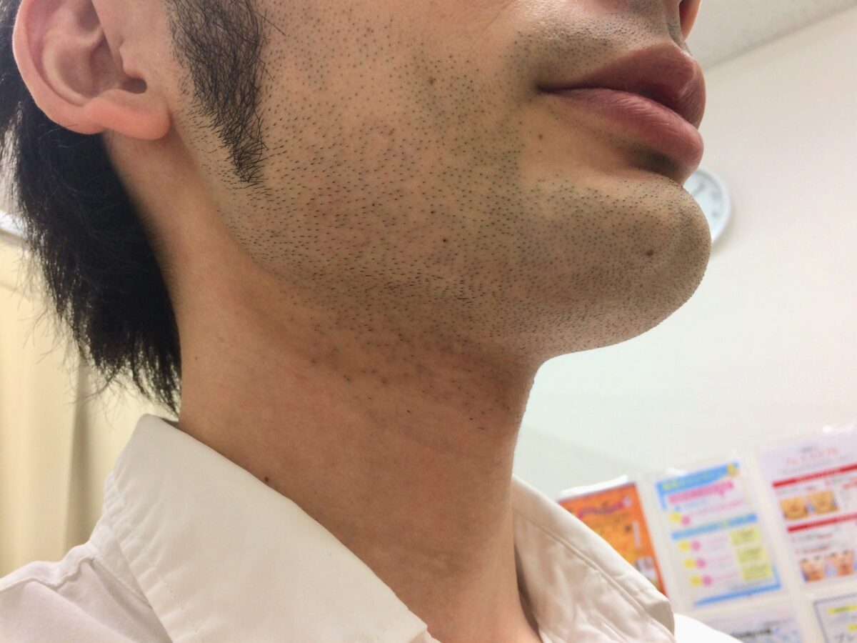 ヒゲ脱毛を始める前