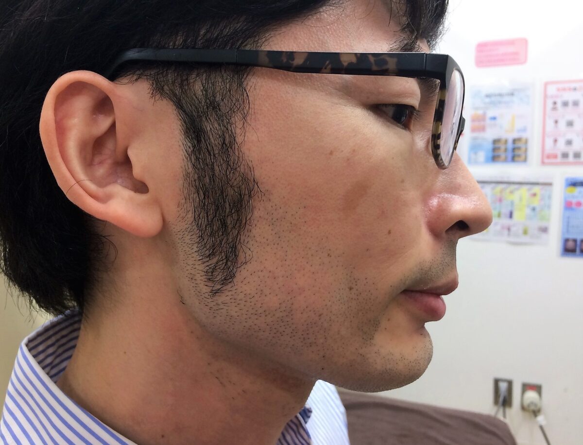 もみあげ脱毛