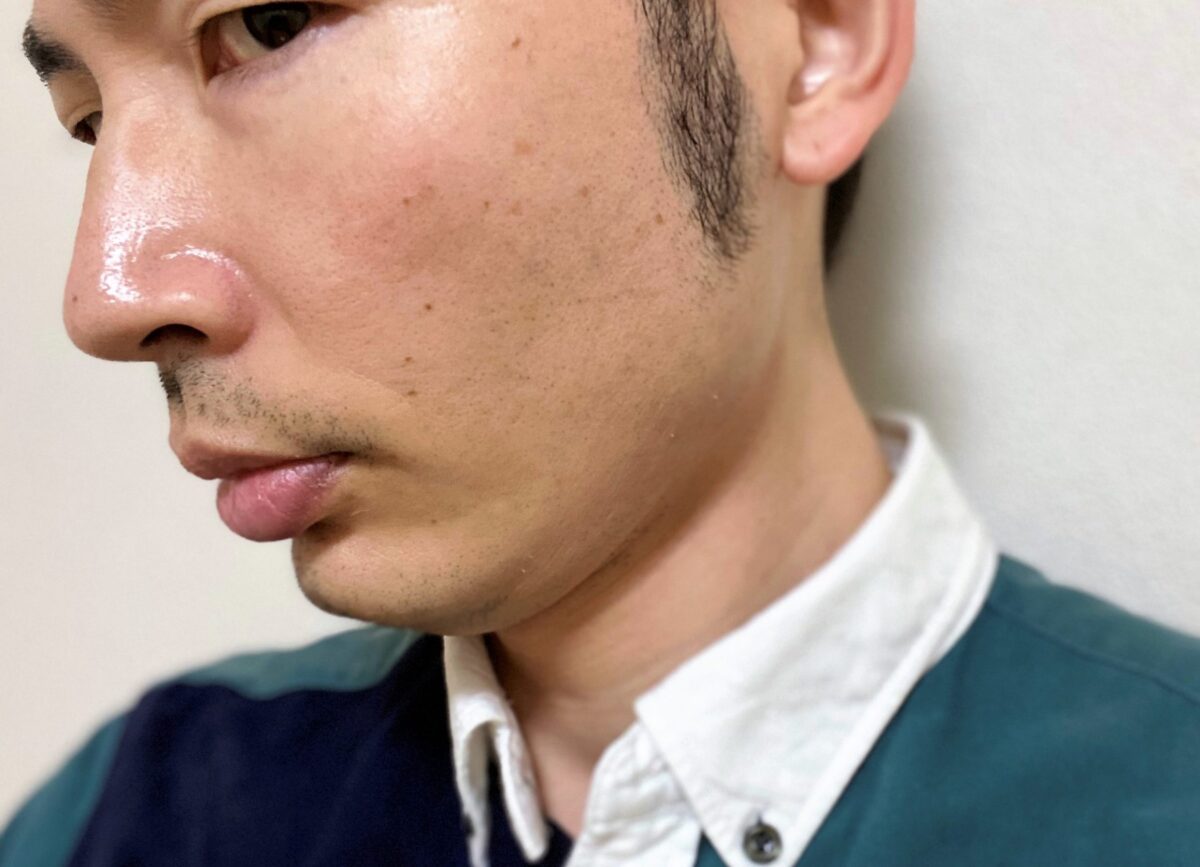 頬ヒゲ脱毛6回目の効果