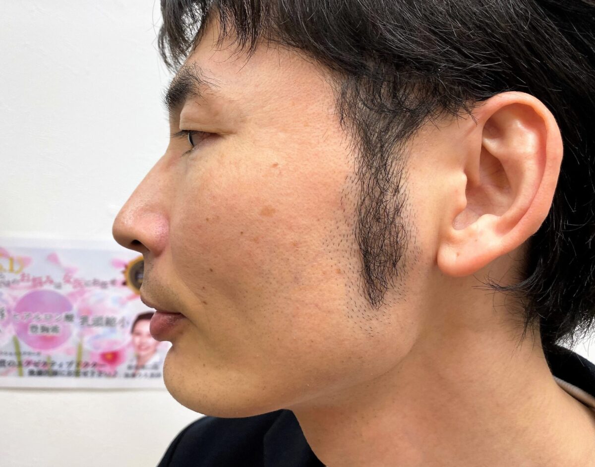 頬ひげ脱毛6回目施術前