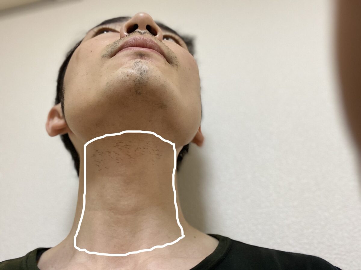 首ヒゲ脱毛の照射範囲