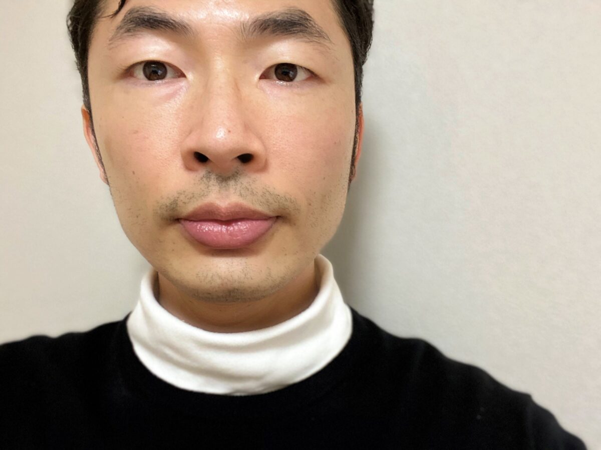 ヒゲ脱毛再生